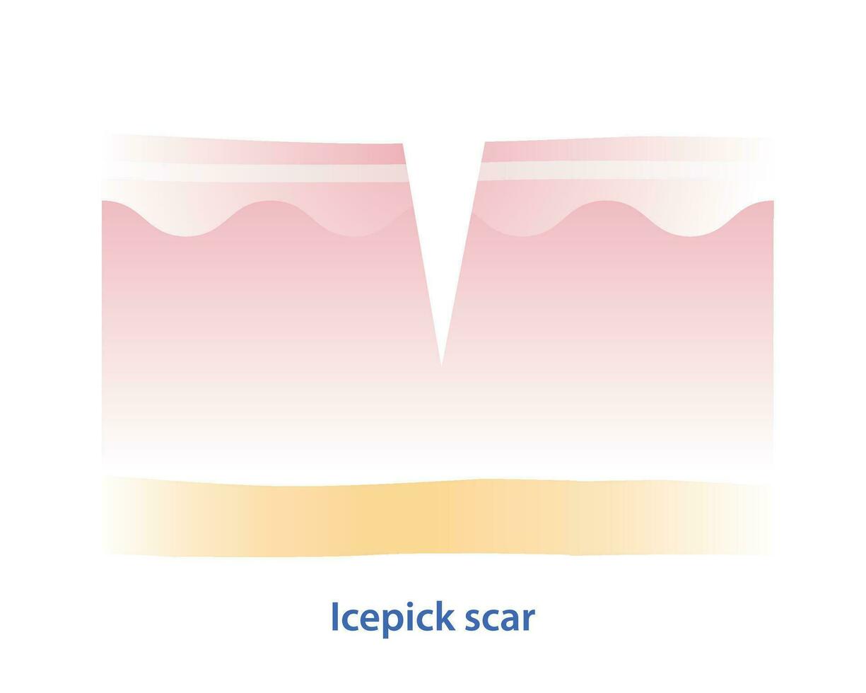 kruis sectie van ijspriem litteken vector illustratie geïsoleerd Aan wit achtergrond. ijspriem litteken, atrofisch litteken, type van acne litteken Aan huid oppervlak. huid zorg en schoonheid concept.