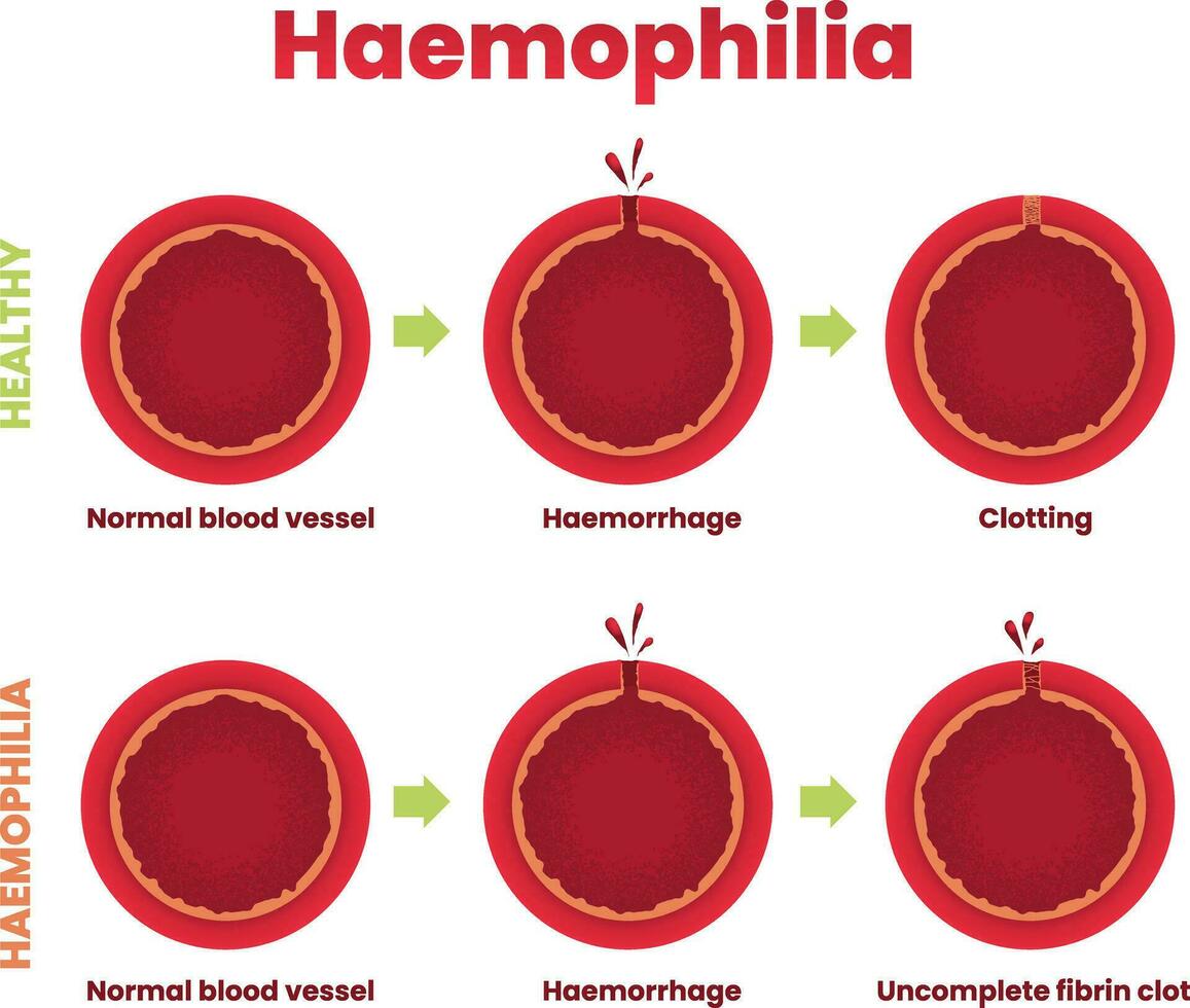 illustratie van hemofilie, gezond bloed vaartuig vs hemofilie infographic vector