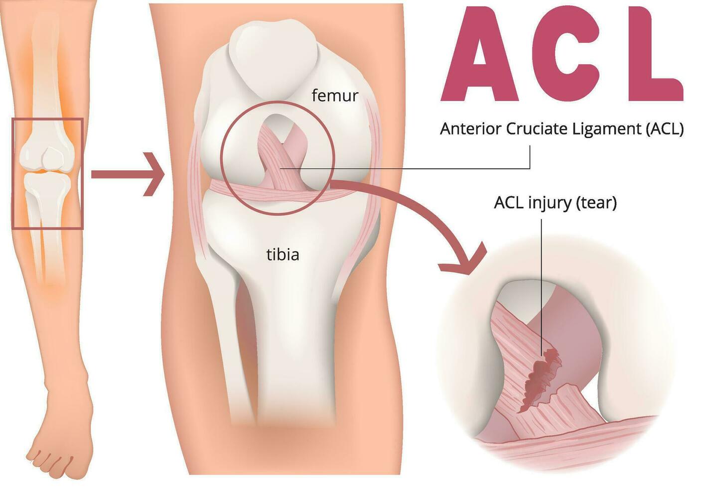 illustratie van acl letsel infographic vector