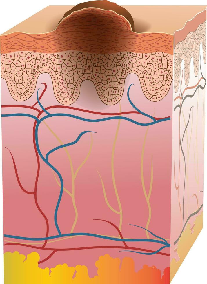 huid kanker kruis sectie illustratie vector