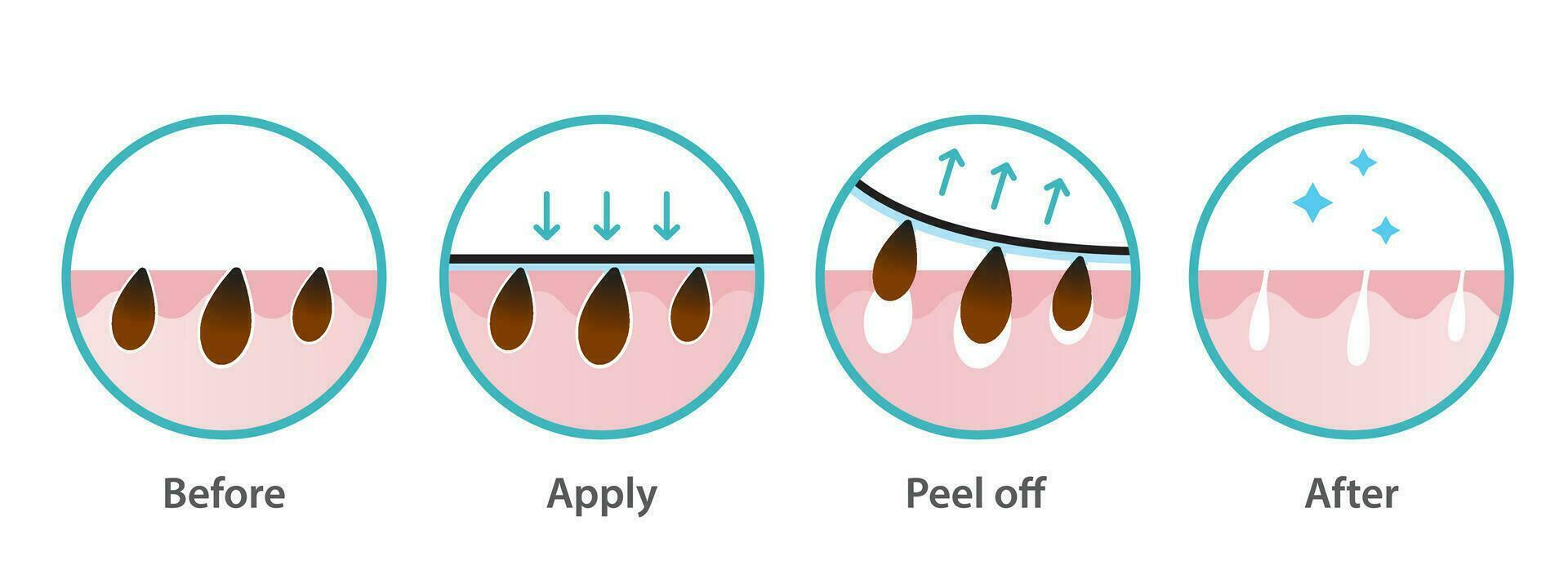 mee-eter verwijdering werkwijze vector icoon reeks illustratie Aan wit achtergrond. kruis sectie van mee-eter porie strip behandeling, van toepassing zijn, Pel uit, ontstoppen en vastdraaien poriën. voordat en na concept.