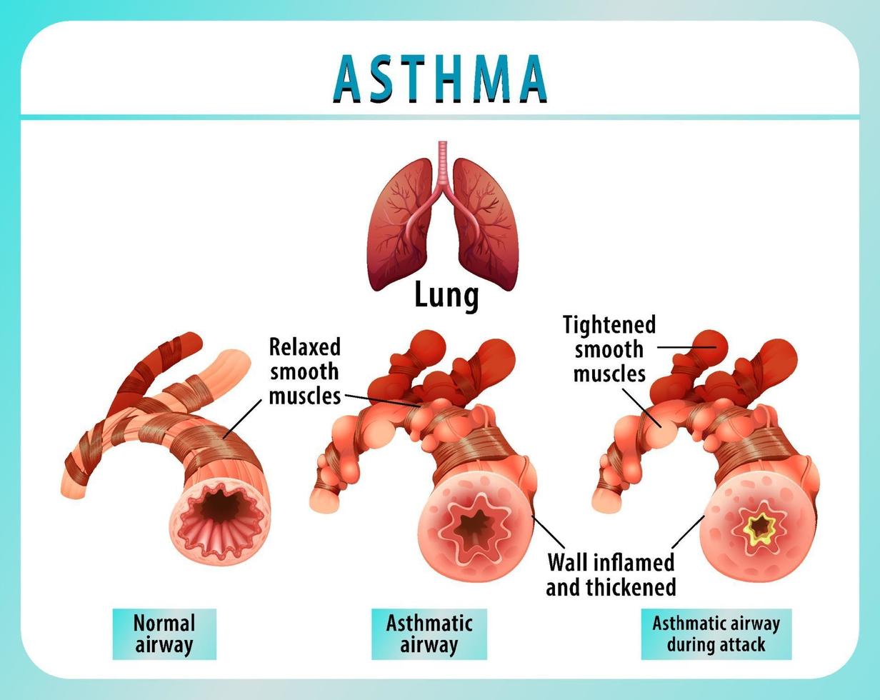 bronchiaal astma diagram met normale luchtweg en astmatische luchtweg vector