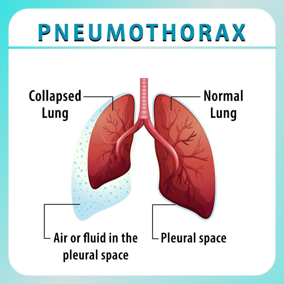 pneumothoraxdiagram met ingeklapte long en normale long vector