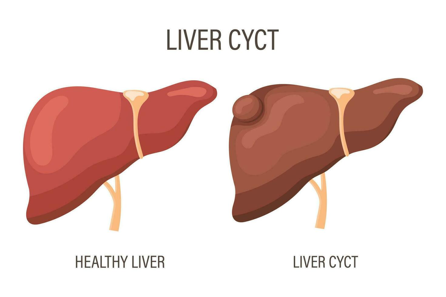 lever cyste, lever ziekte. gezond lever en lever cyste. medisch infographic spandoek. vector