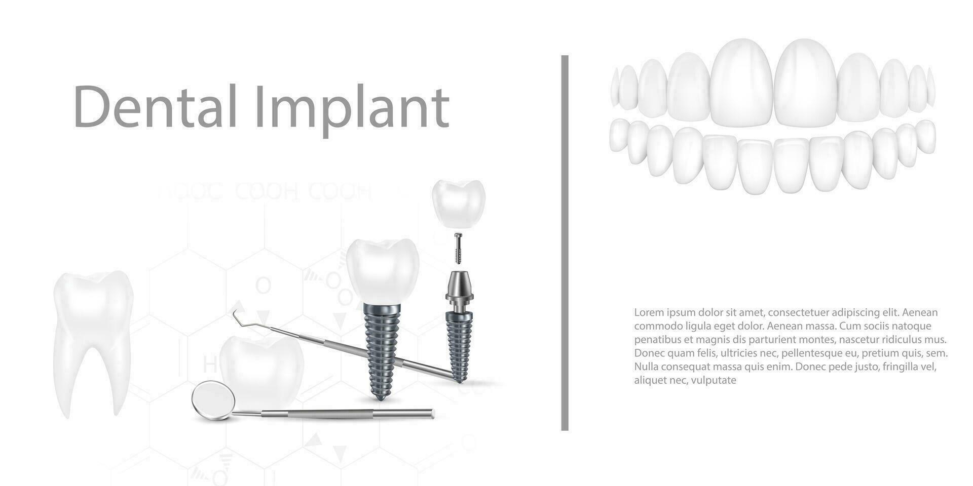 tandheelkundig implantaat structuur medisch schilderachtig educatief infographic poster met kies vervanging einde gezond gereedschap modellen vector illustratie.