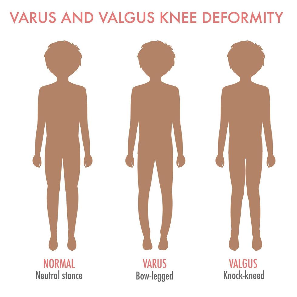 valgus, varus knie, benen ziekte, vervorming infographic vector