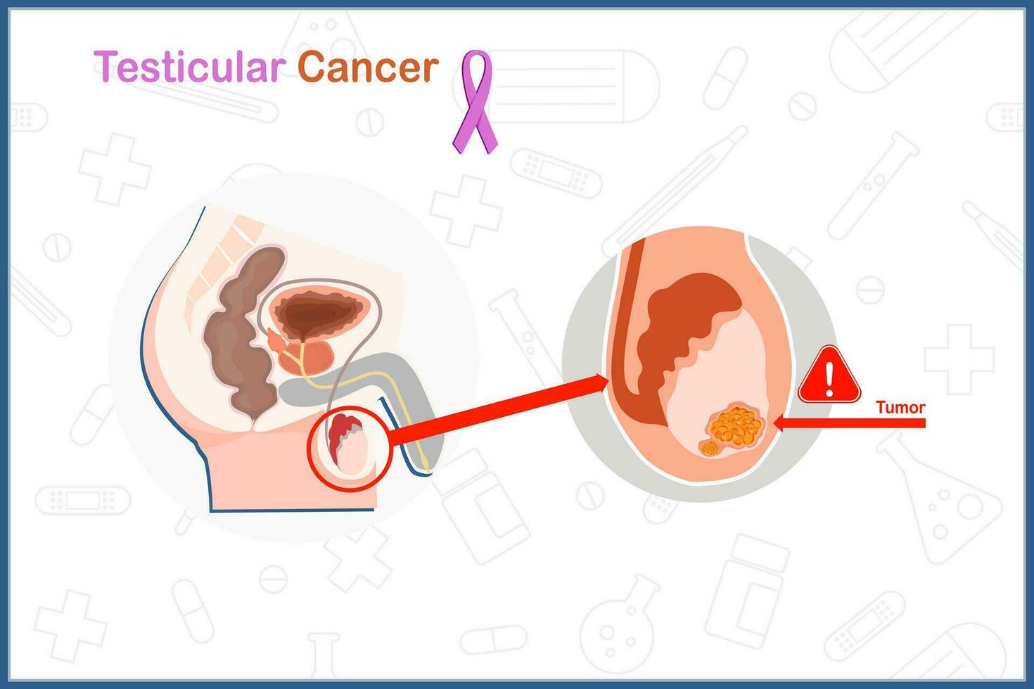 vlak medisch vector in testiculaire kanker concept. een mannetje anatomie van testiculaire kanker illustratie geïsoleerd Aan wit achtergrond.