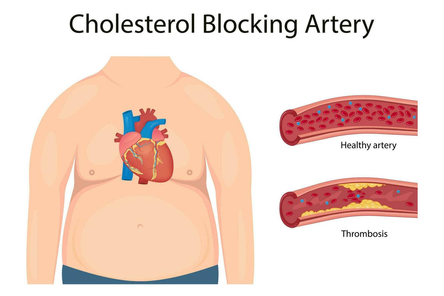atherosclerose concept, Gezondheid risico. menselijk hart. medisch vector