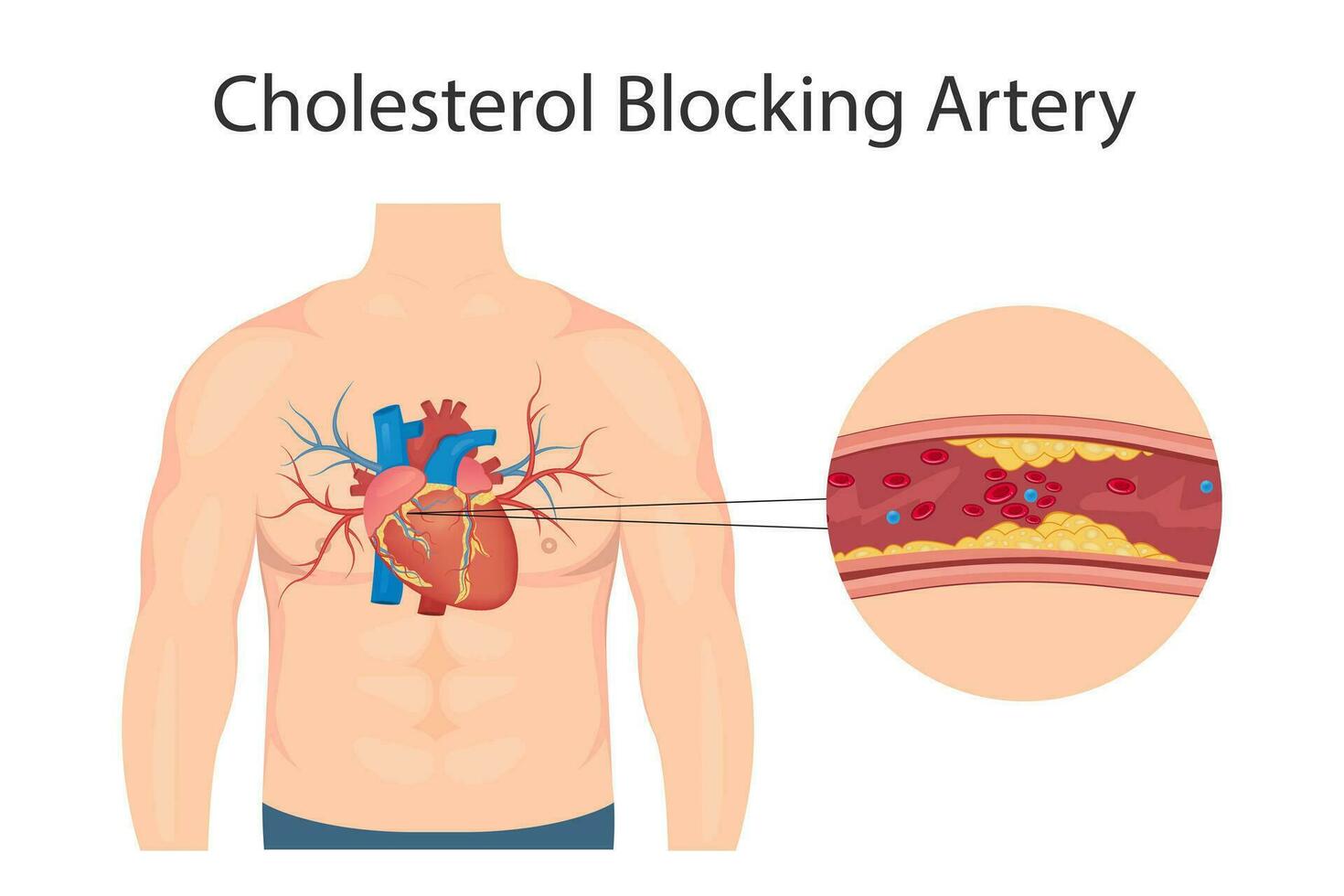 atherosclerose concept, Gezondheid risico. menselijk hart. medisch vector illustratie