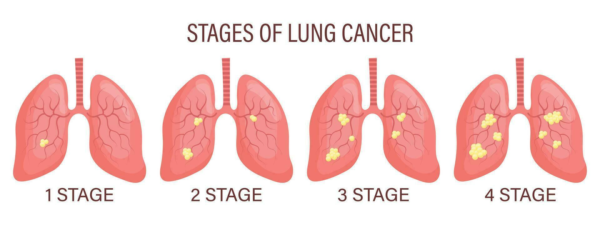 stadia van long kanker, long ziekte. medisch infographic banier, illustratie, vector