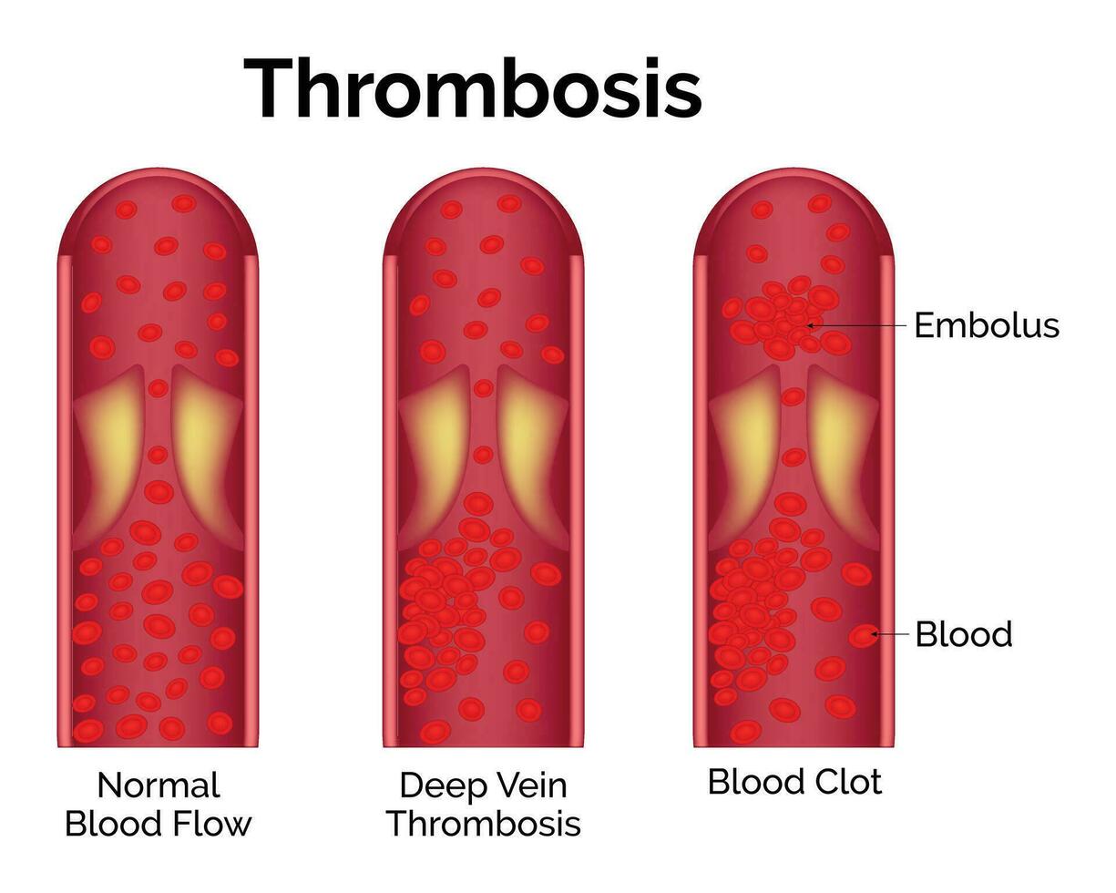 trombose wetenschap sesign vector ontwerp illustratie