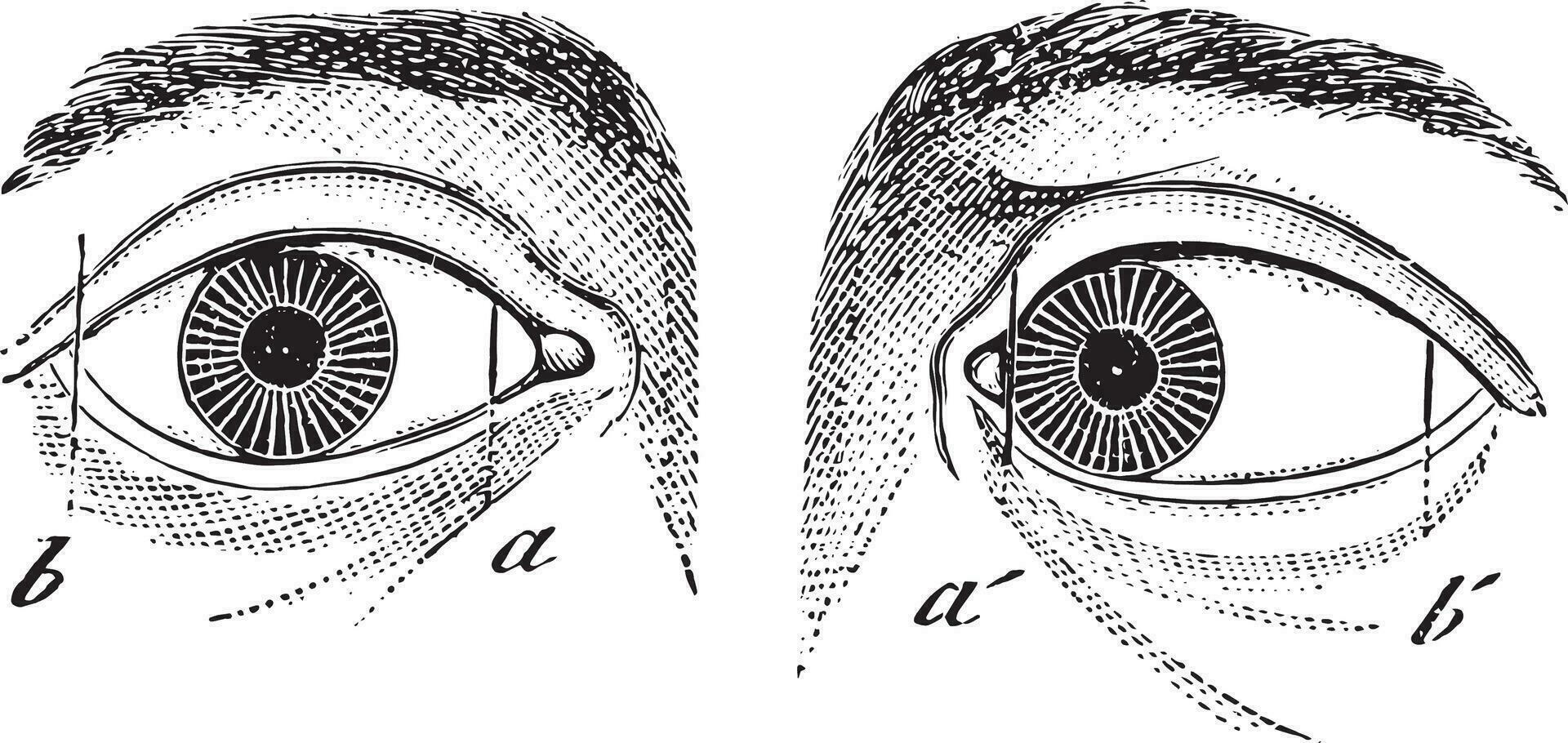 esotropie van de links oog, wijnoogst gravure. vector