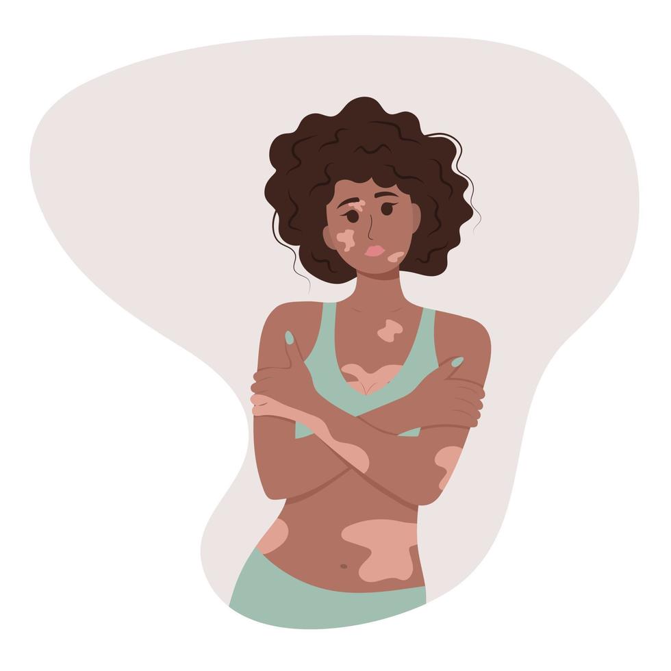 mooie Afro-Amerikaanse vrouw met vitiligo. vector