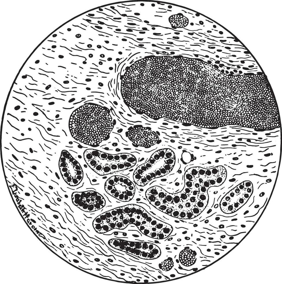 aangeboren cystic ziekte van de nier, wijnoogst gravure. vector