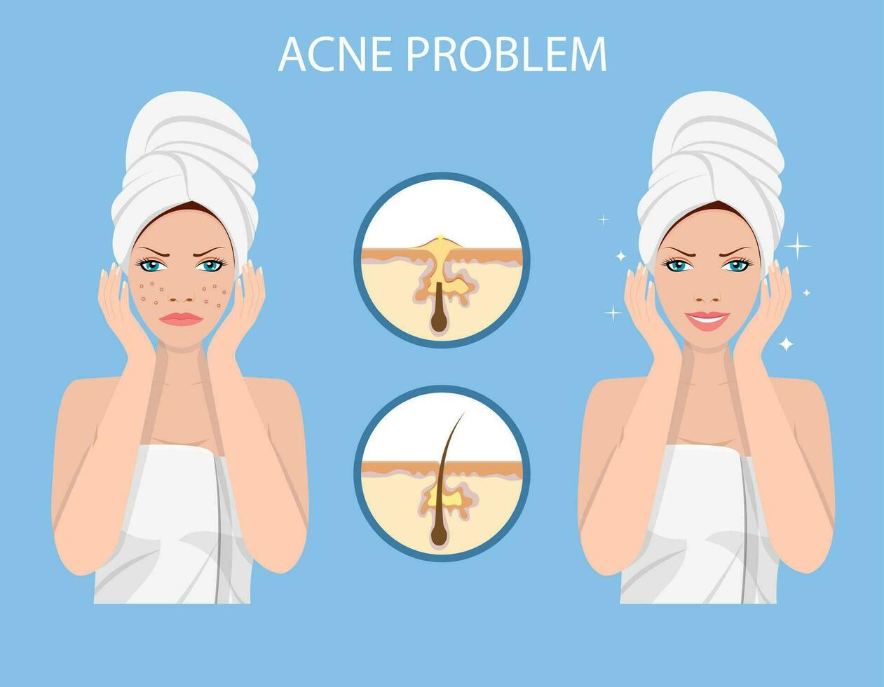 gezicht met acne. vrouw gelaats huid probleem. spa schoonheid en Gezondheid concept. vector illustratie in vlak stijl