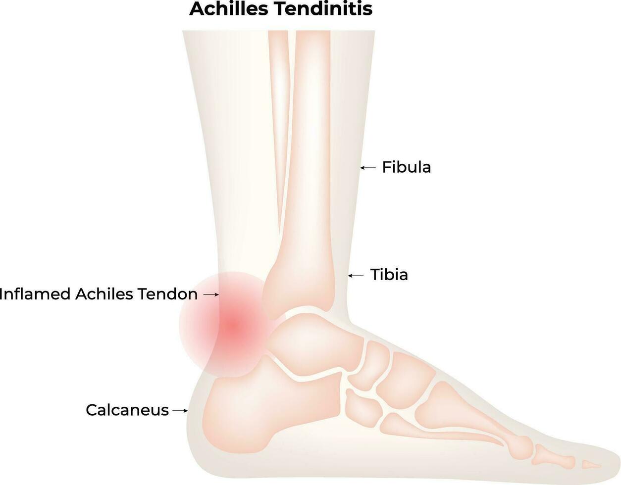 Achilles tendinitis wetenschap ontwerp vector illustratie