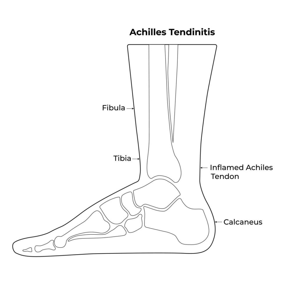 Achilles tendinitis wetenschap ontwerp vector illustratie