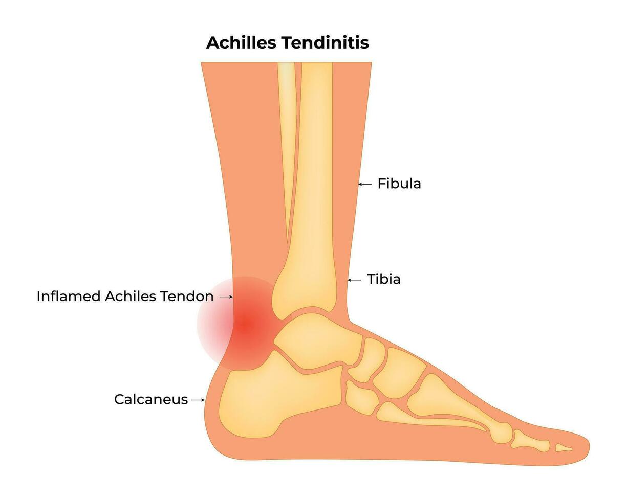 Achilles tendinitis wetenschap ontwerp vector illustratie