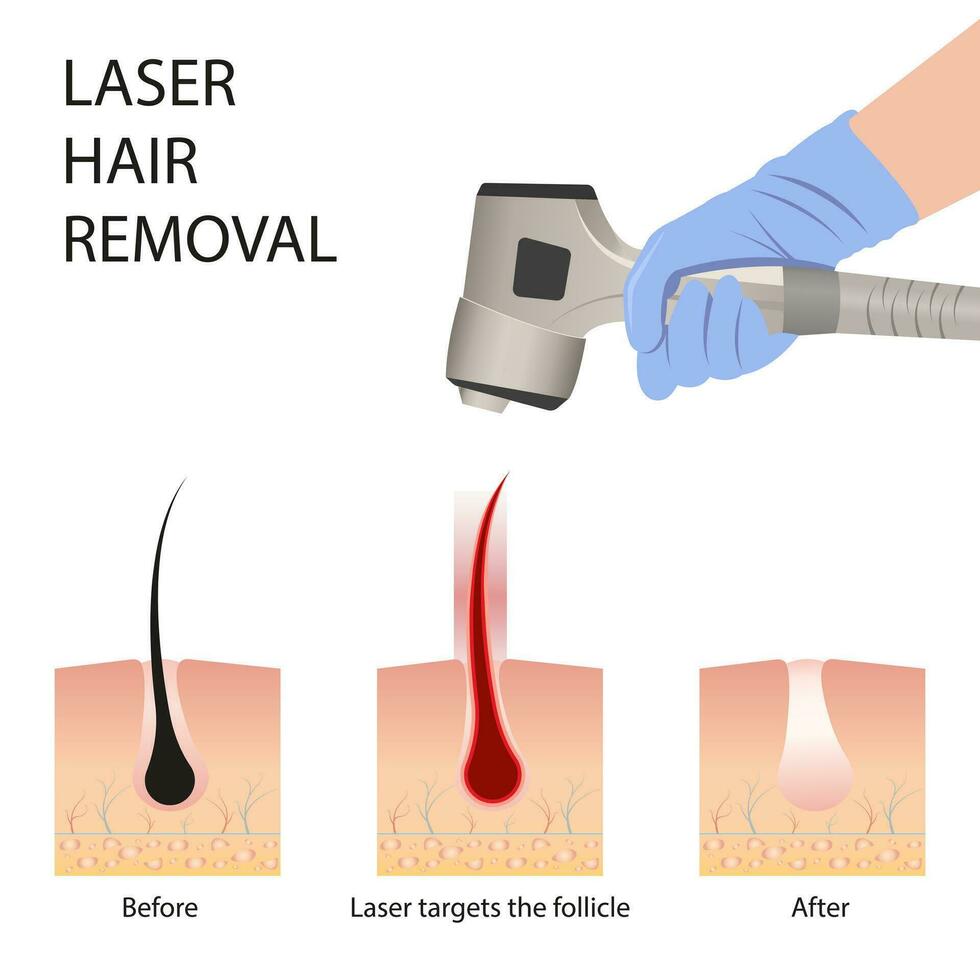 laser haar- verwijdering van de huid laag en follikel voor schoonheid en gladheid van de lichaam. haar- verwijdering procedure vector