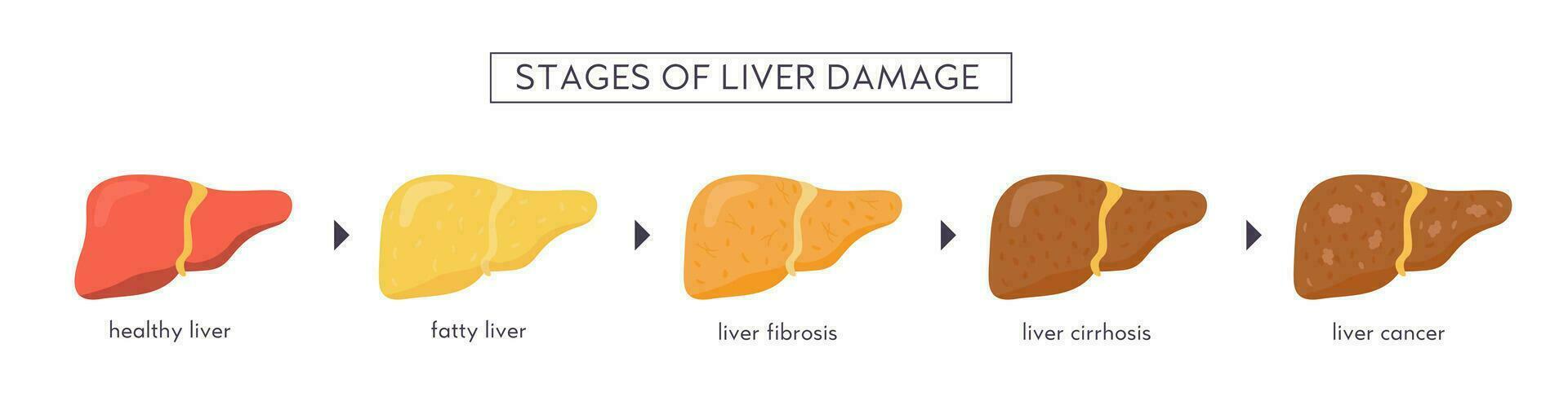 stadia van niet alcoholisch lever schade. gezond, vet, steatose, nash, fibrose, cirrose, kanker. medisch infographic van lever ziekte. vector banier in vlak tekenfilm stijl Aan wit achtergrond.