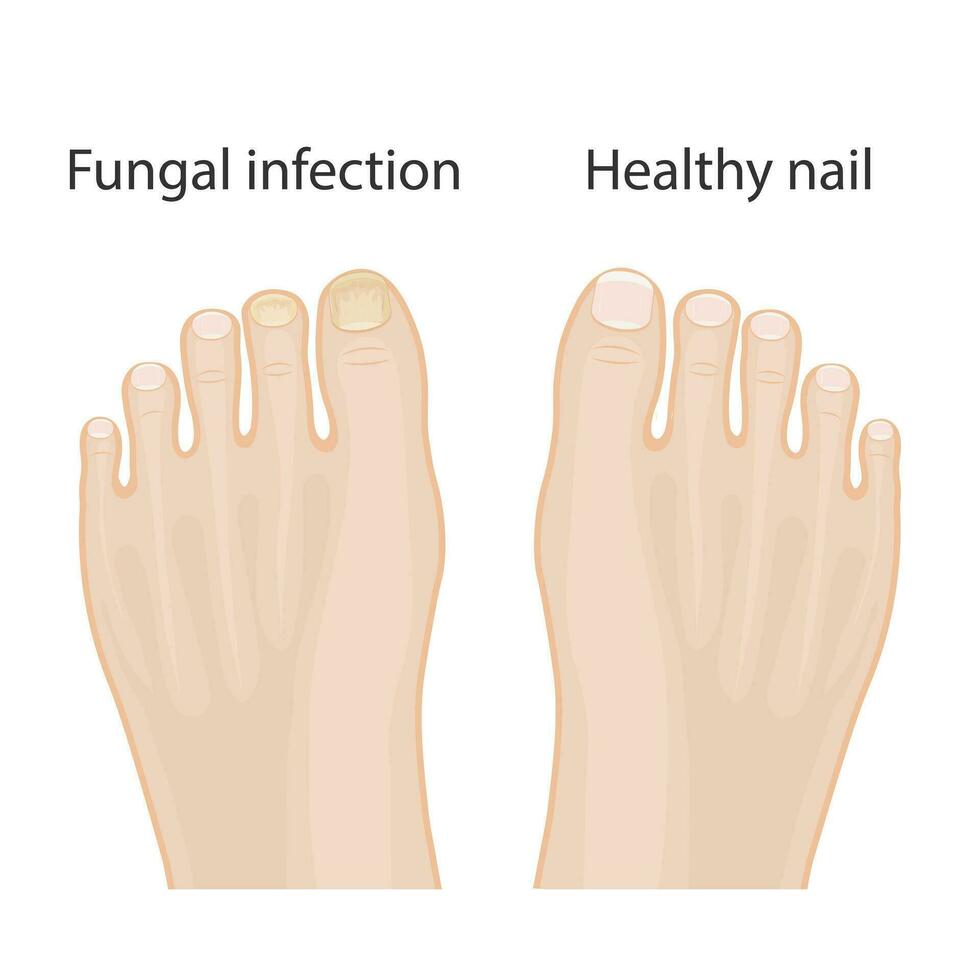 nagel ziekten. onychomycose, oorzaken van schimmel nagel infectie. medisch infographic ontwerp vector