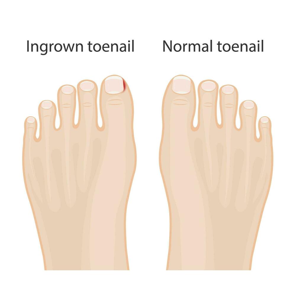 illustratie van gezond voeten, voeten met ingegroeide teennagels, behandeling van ingegroeide teen en teen vector