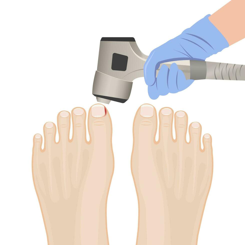 illustratie van gezond voeten, voeten met ingegroeide teennagels, behandeling van ingegroeide teen en teen vector