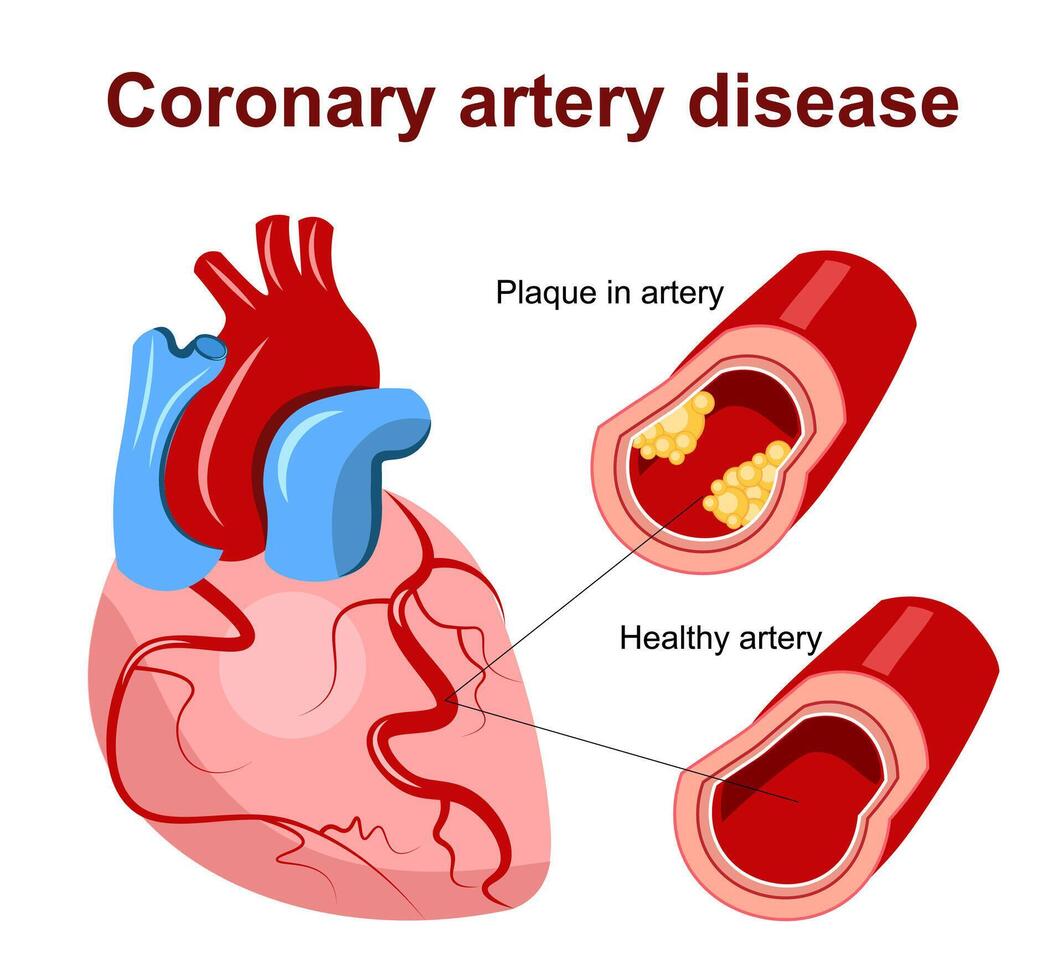 coronaire hartziekte vector