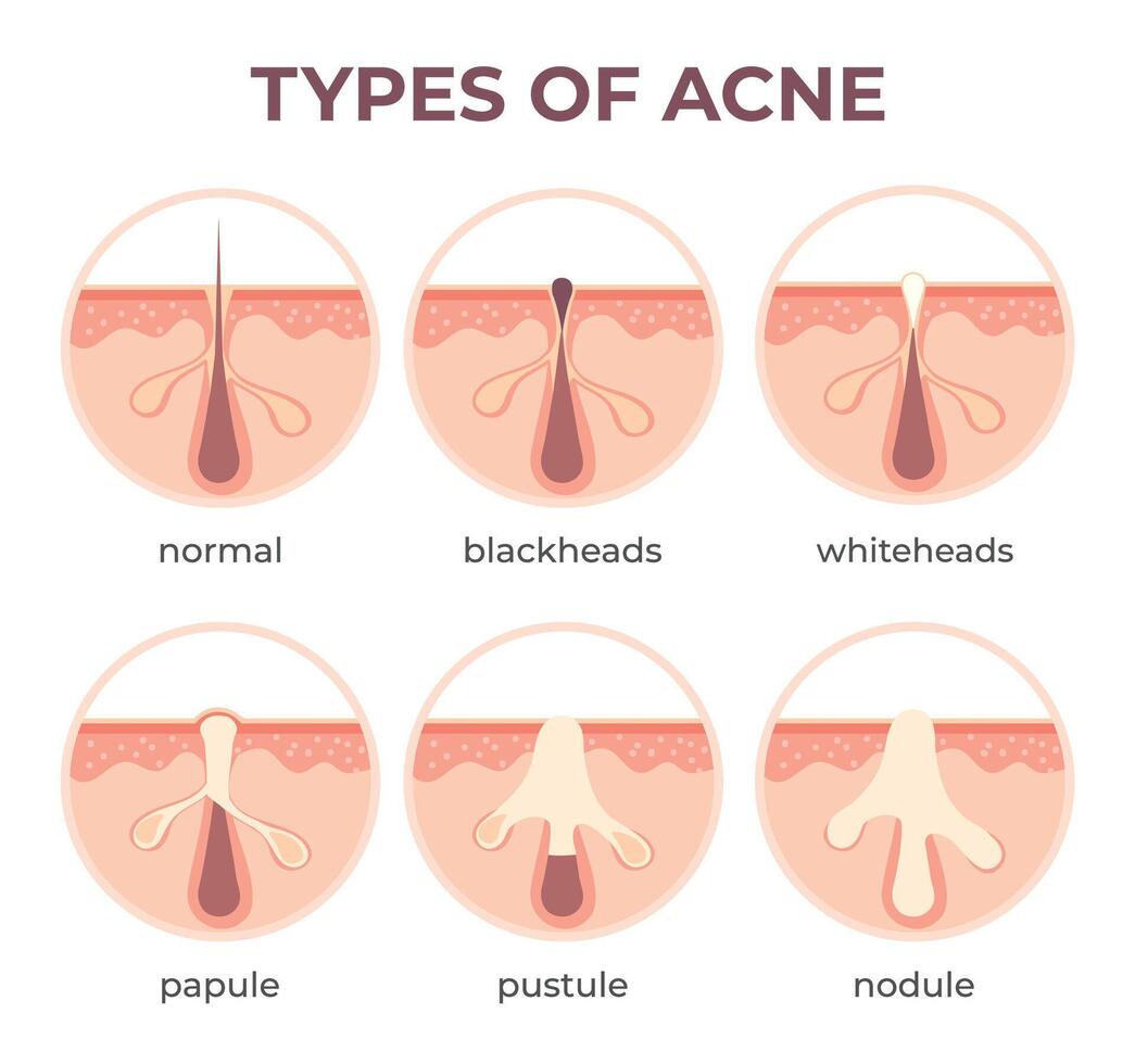 acne types anatomie. puistje ziekten sectioneel visie mee-eter, cystic en withoofd. structuur van huid en porie infectie vector infographic