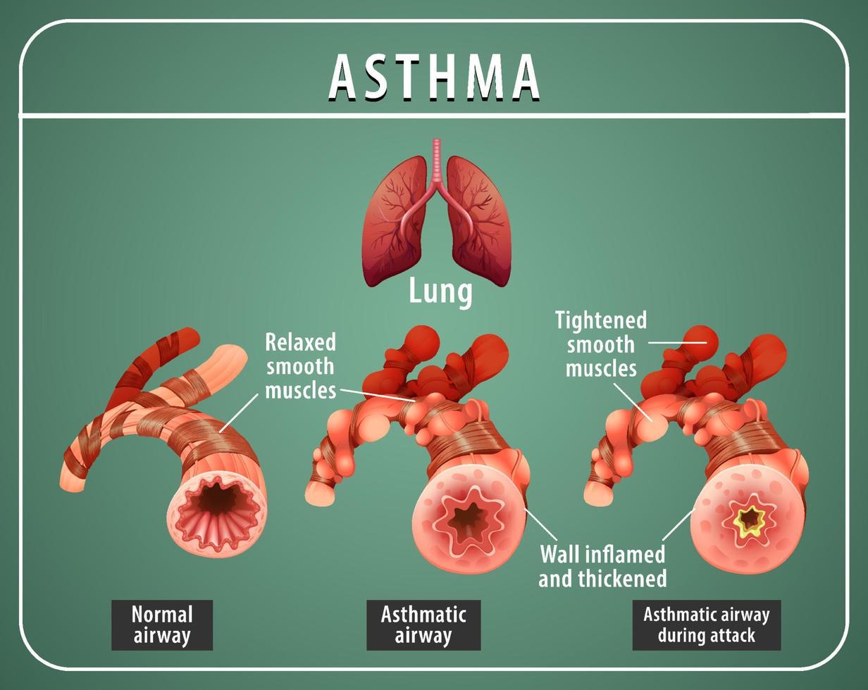 astmadiagram met normale luchtweg en astmatische luchtweg vector