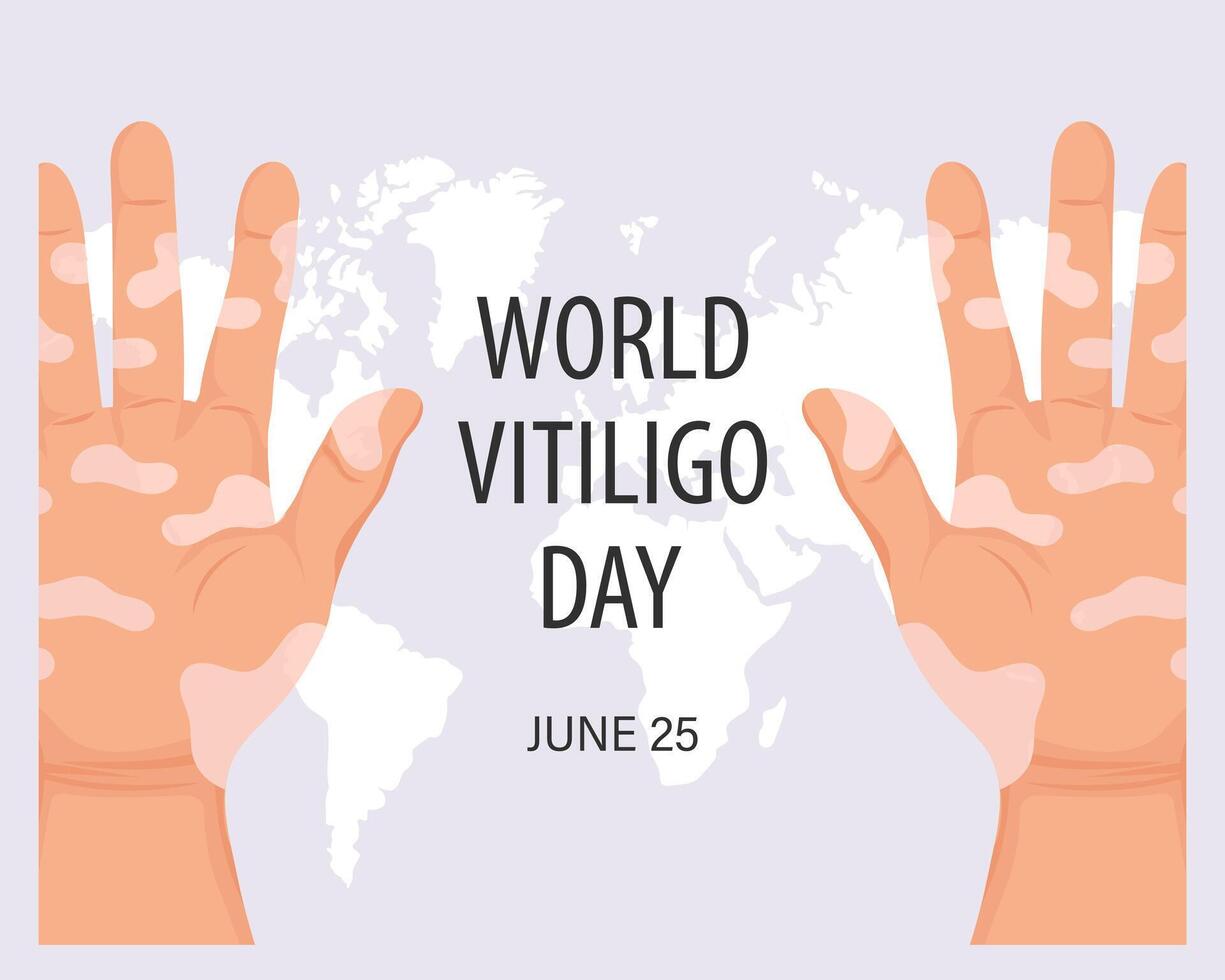 handen met dermatologisch ziekte vitiligo. geneeskunde concept. wereld vitiligo dag, bewustzijn spandoek. banier, poster, vector
