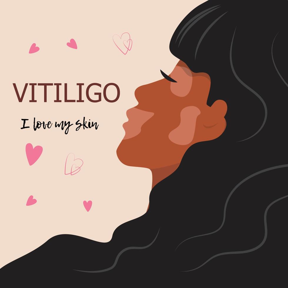 vitiligo-huid. vitiligo donker vrouwelijk gezicht in profiel. donkere huid meisje. diversiteit tolerantie concept. vector