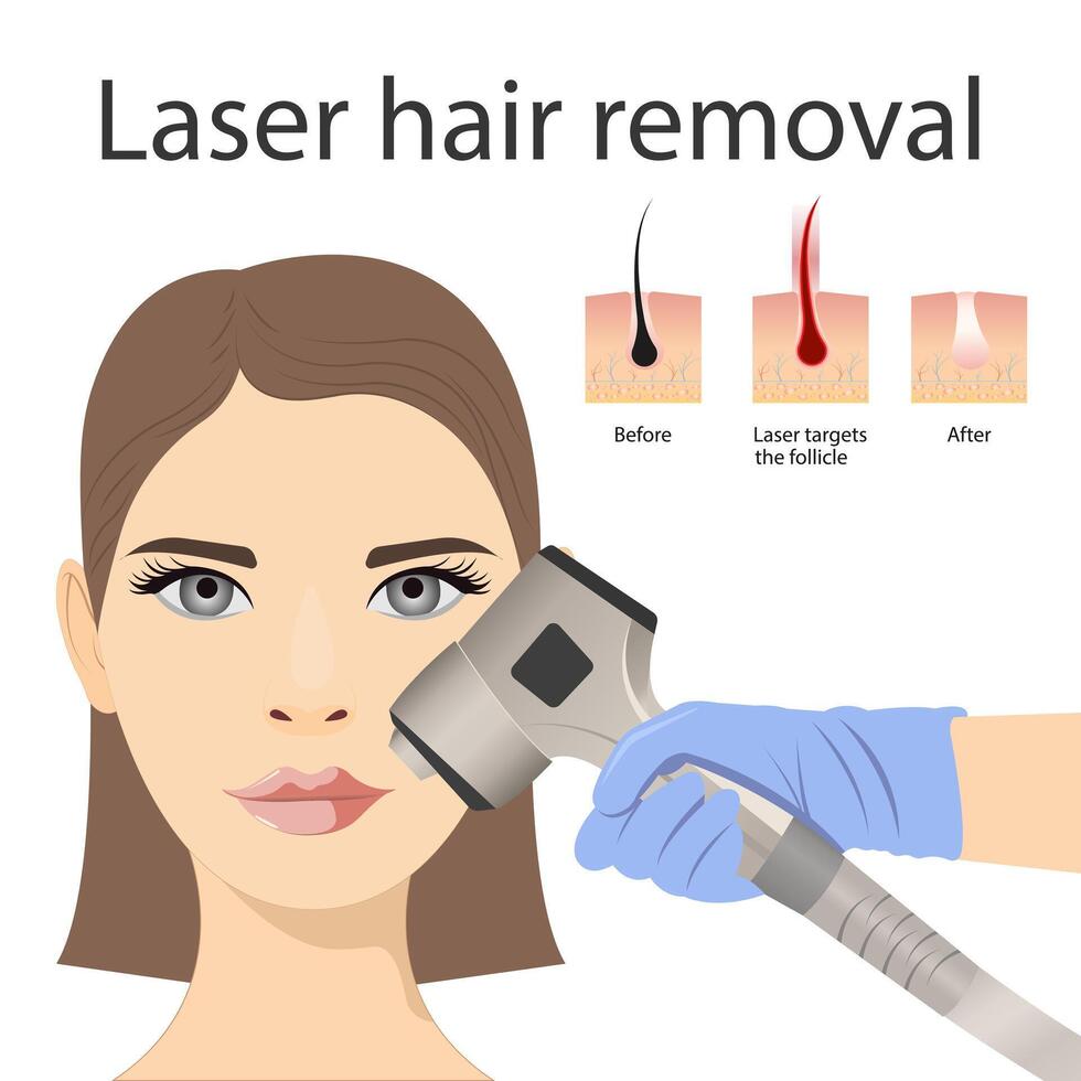 haar- infographic structuur. laser haar- verwijdering vector