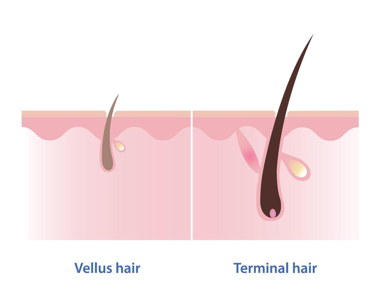 de verschil tussen vellus haar- en terminal haar- vector Aan wit achtergrond. haar- soorten. vellus haar- is prima, piekerig en ongepigmenteerd haar. terminal haar- is dik, ruw, lang en gepigmenteerd haar.