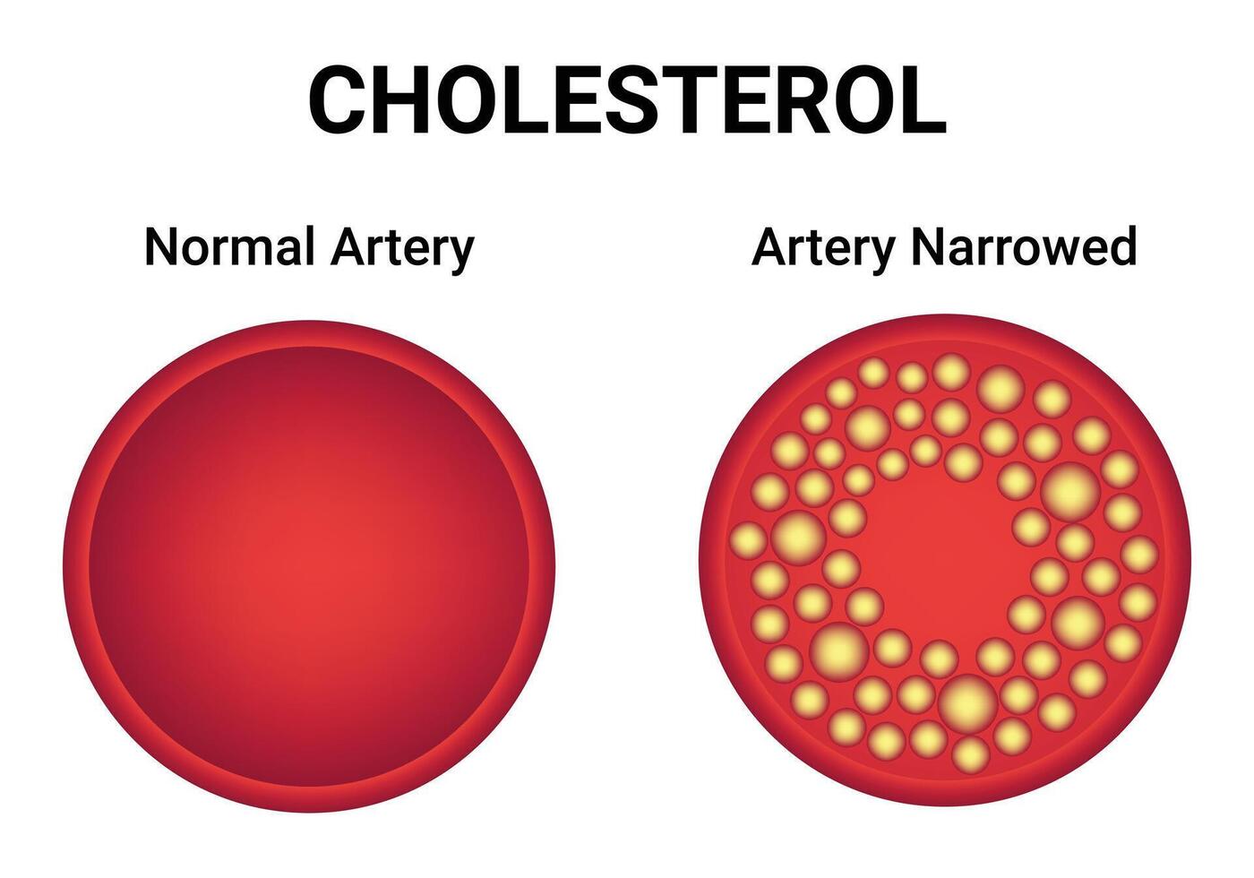 cholesterol normaal slagader versmald slagader wetenschap ontwerp vector illustratie diagram