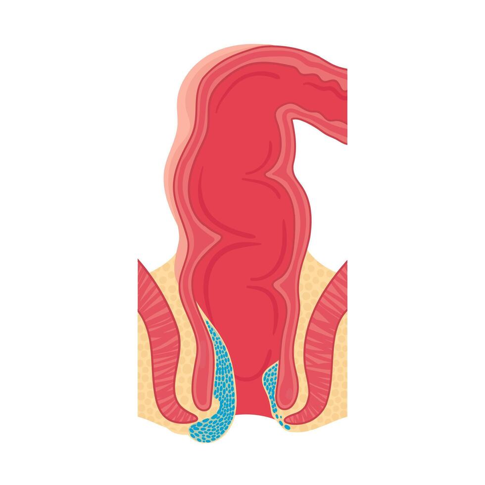 aambeien in de rectum. vector illustratie in tekenfilm stijl.