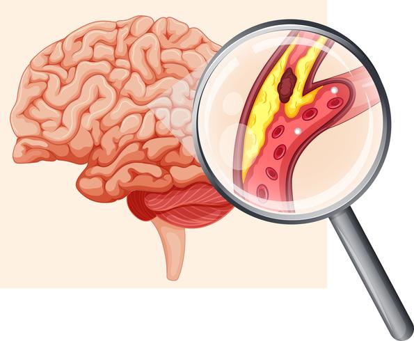 Menselijke hersenen met atherosclerose vector