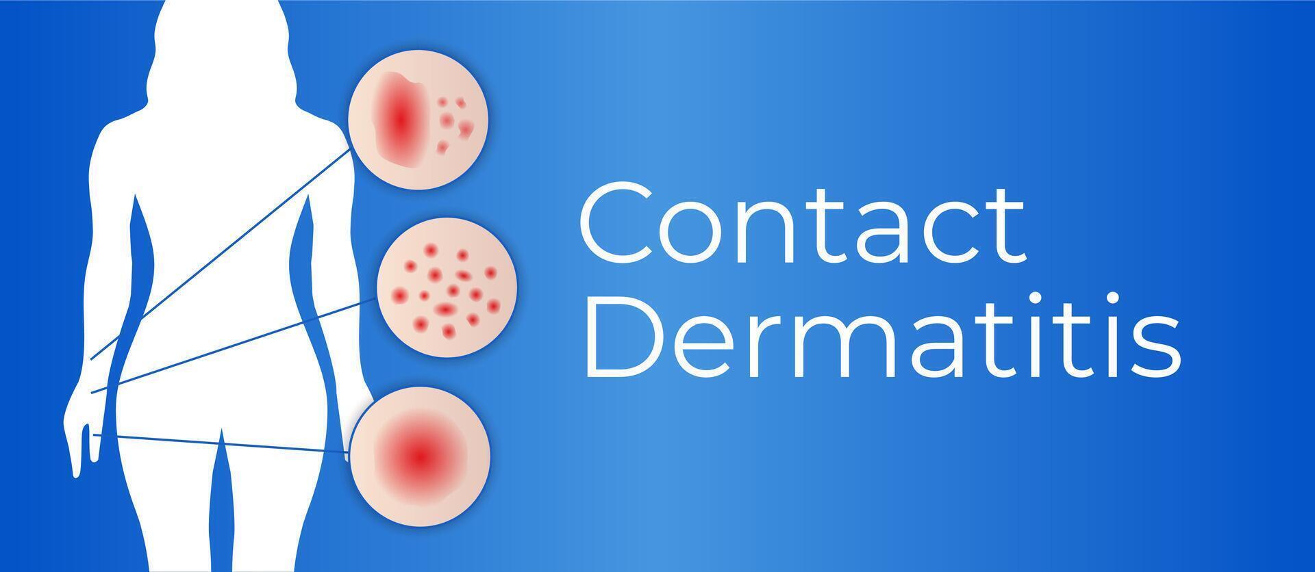 contact dermatitis achtergrond illustratie vector