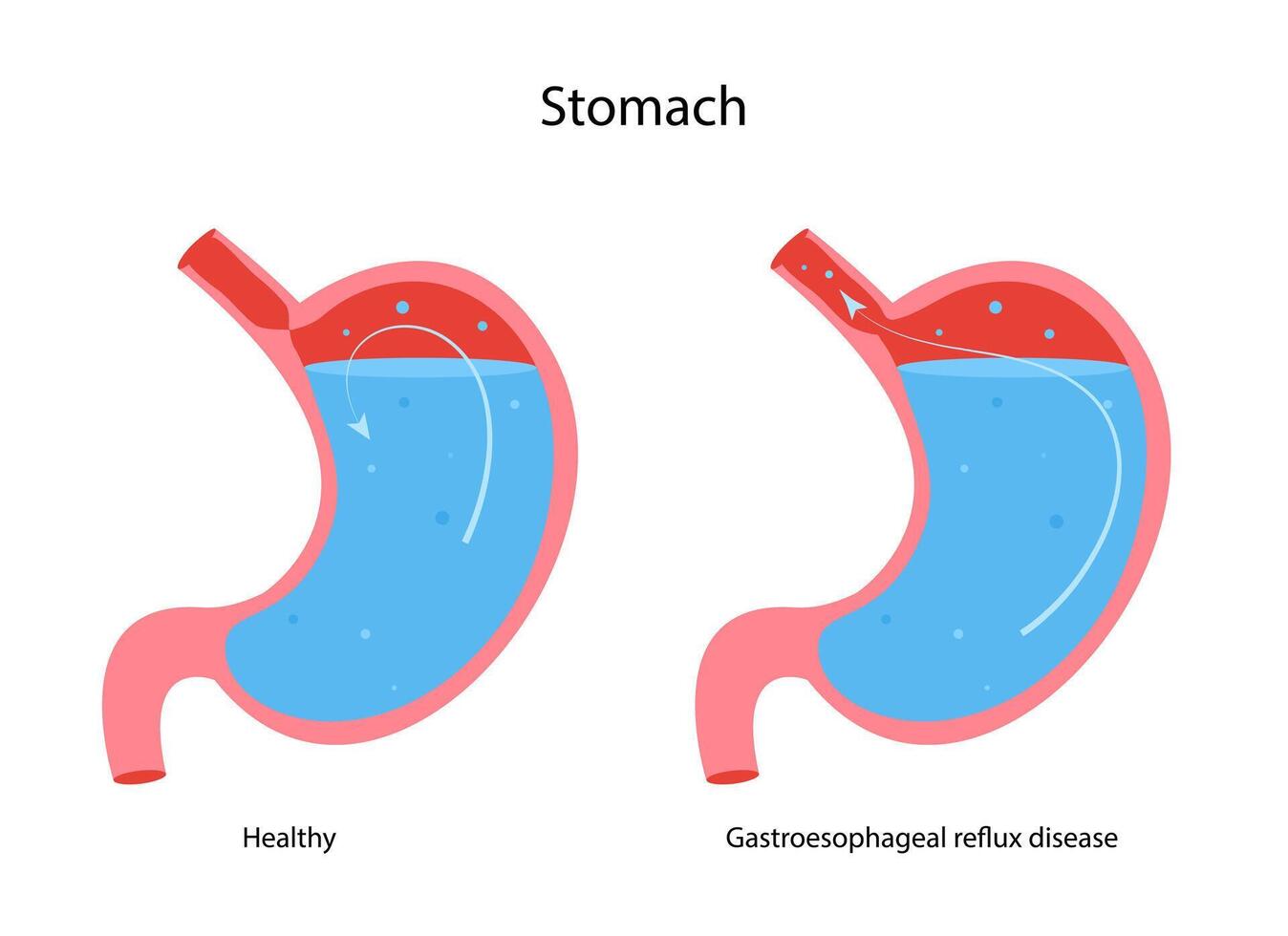 gastro-oesofageale reflux ziekte maag. gerd, maagzuur. normaal intern orgaan en maag met zuur reflux vector