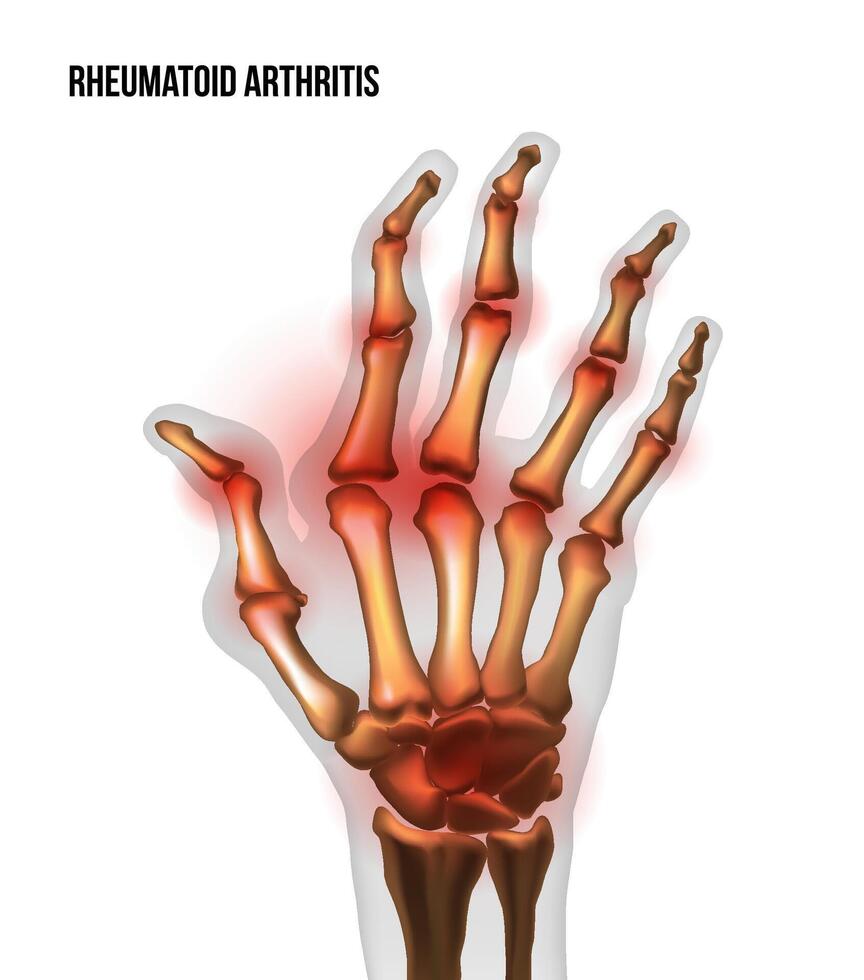 reumatoïde artritis beeld zeer ontsteking gewrichten van botten de van hand. vector