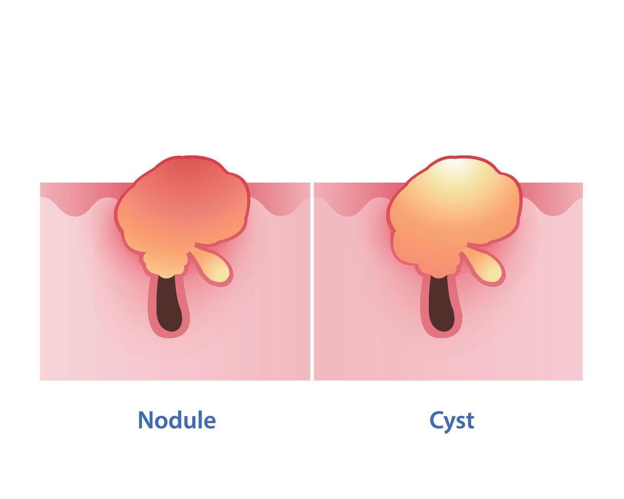 de verschil tussen knobbel en cyste vector Aan wit achtergrond. nodulair is stevig, pijnlijk, rood buil Aan de oppervlakte huid. cystic acne bestaan uit van diep, pus gevuld. de beide zijn opruiend streng.