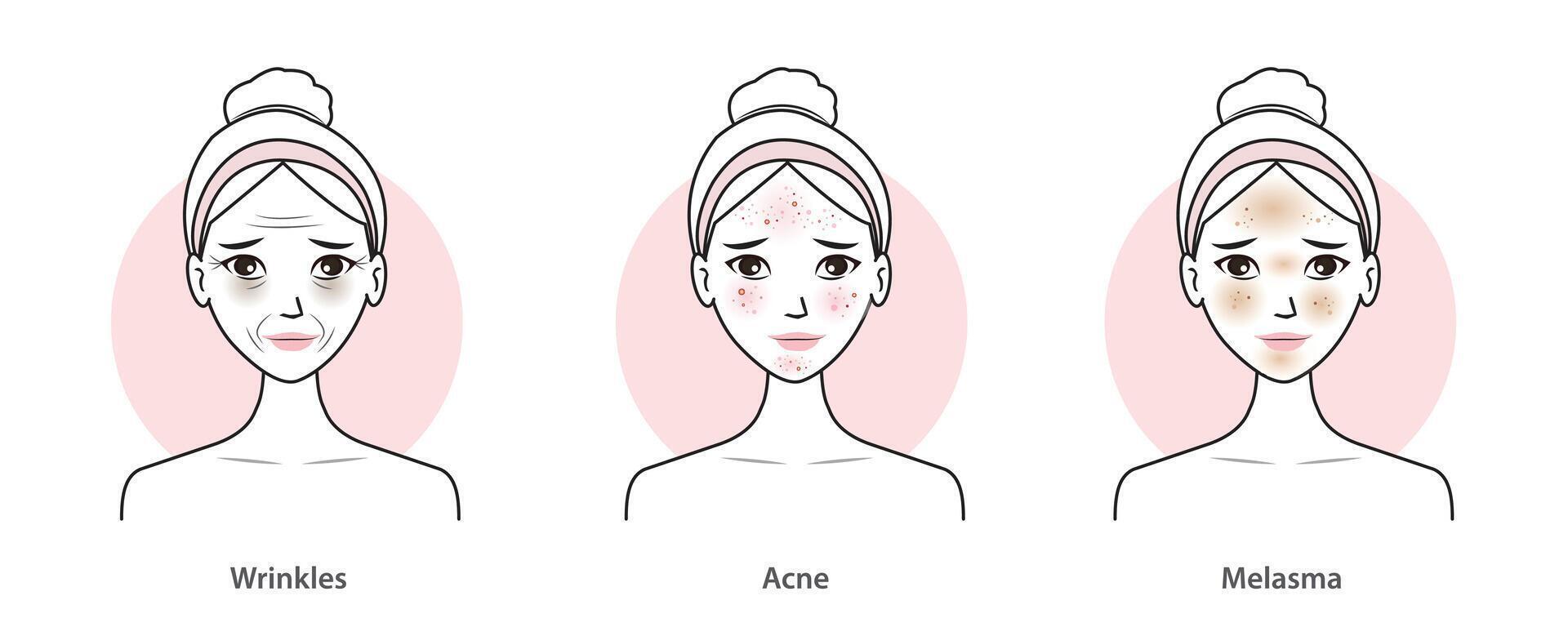 infographic van huid problemen reeks vector illustratie. schattig Dames met rimpels, veroudering, donker cirkels, acne, litteken, melasma, hyperpigmentatie en donker vlekken Aan gezichten. huid zorg en schoonheid concept.