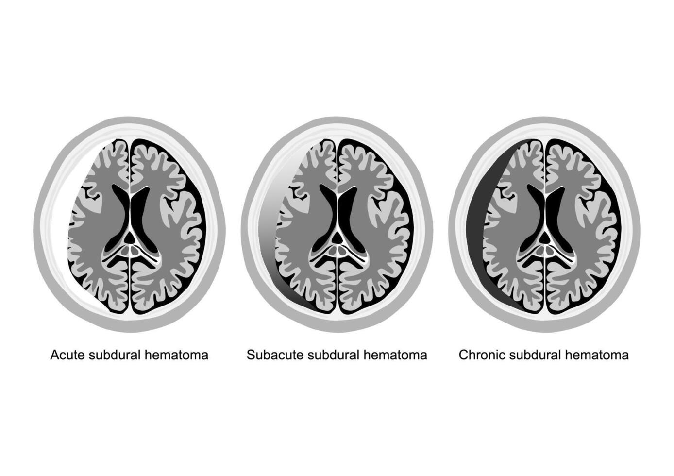 stadia van subduraal hematoom hersenen letsel geïllustreerd. vector