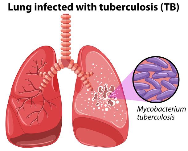 Long besmet met tuberculose vector