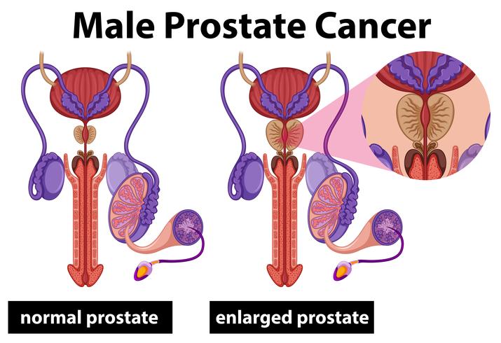 Menselijke mannelijke prostaatkanker vector