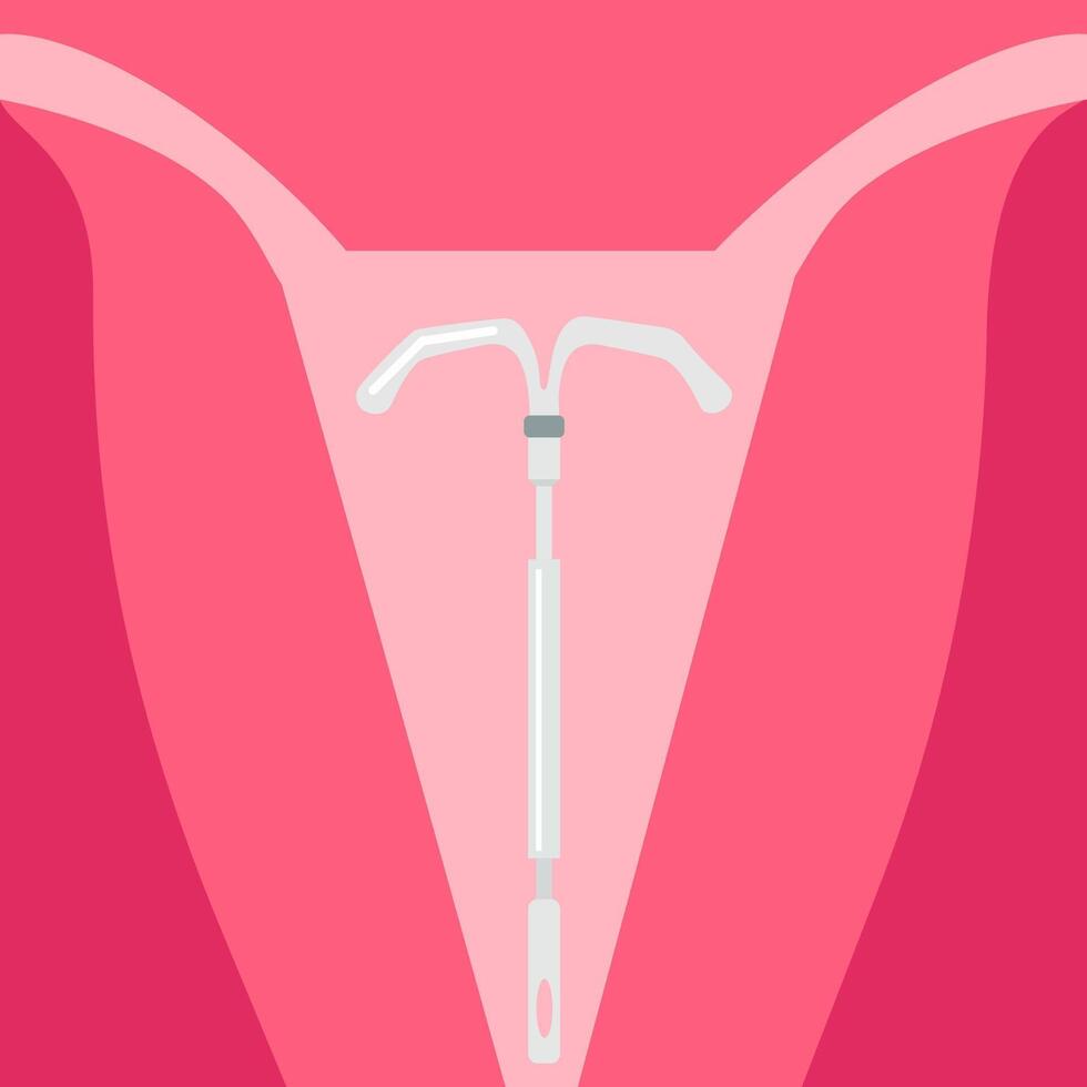 de methode van anticonceptie is een intra-uterien spiraal. illustratie vector