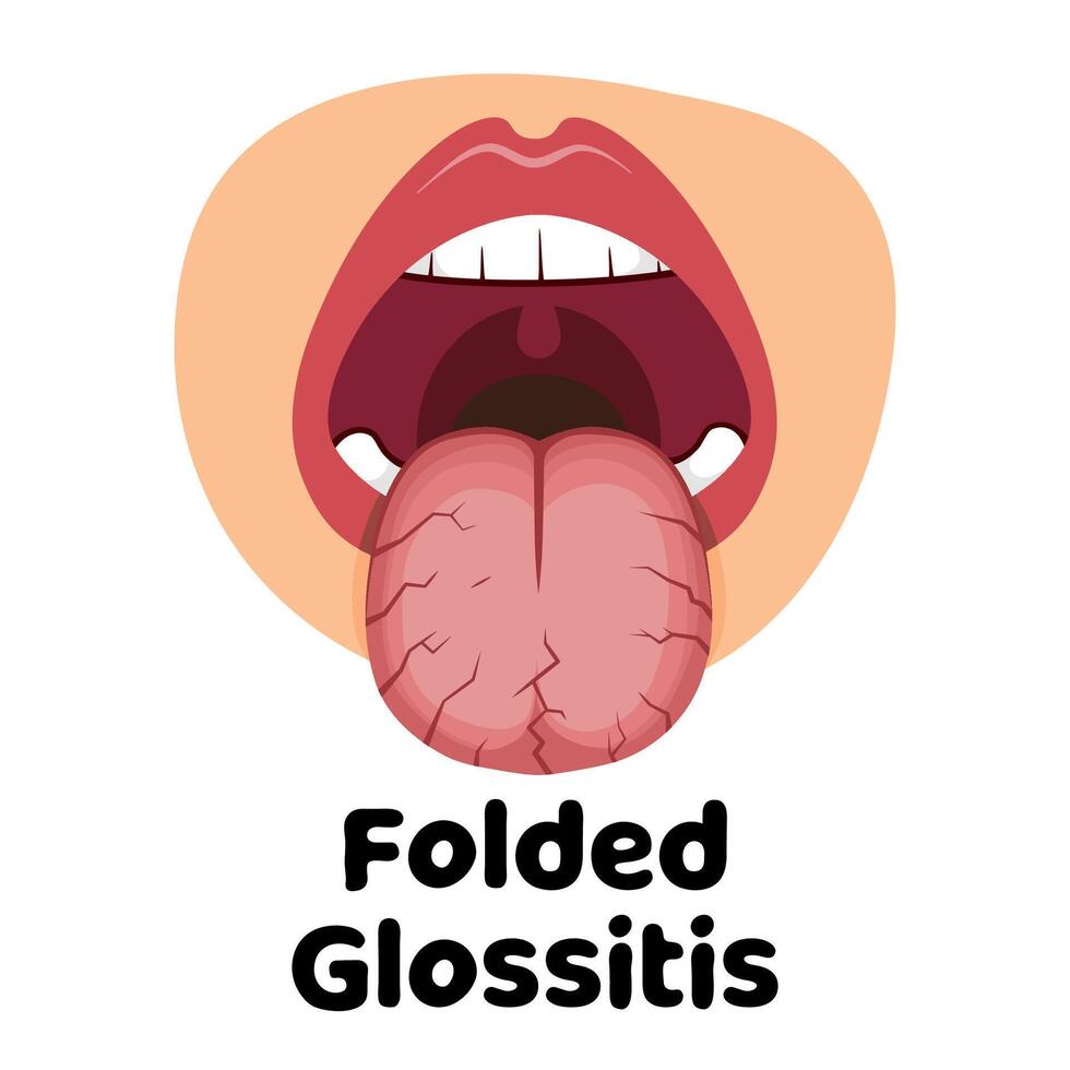 gevouwen glossitis illustratie vector