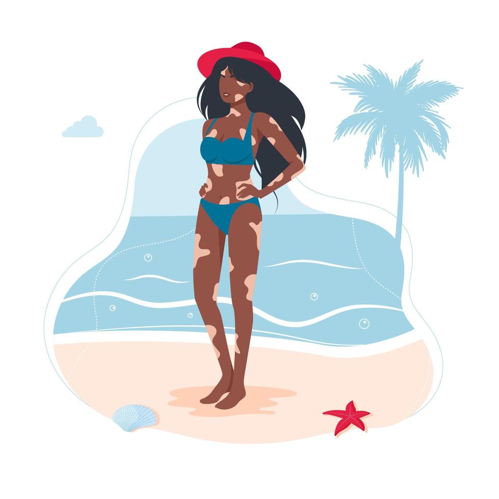 vitiligo huidziekte bij Afro-Amerikaanse meisje in een zwembroek. vrouw met een diagnose van vitiligo zonnebaden op het strand is niet verlegen. het concept van verschillende schoonheid, lichamelijk positief, zelfacceptatie. vector