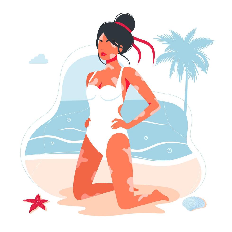 vitiligo huidziekte bij een meisje op het strand in een zwembroek. vrouw die op het strand zonnebaadt met een diagnose van vitiligo aarzelt niet. concept van verschillende schoonheid, lichaamspositief, zelfacceptatie. vector