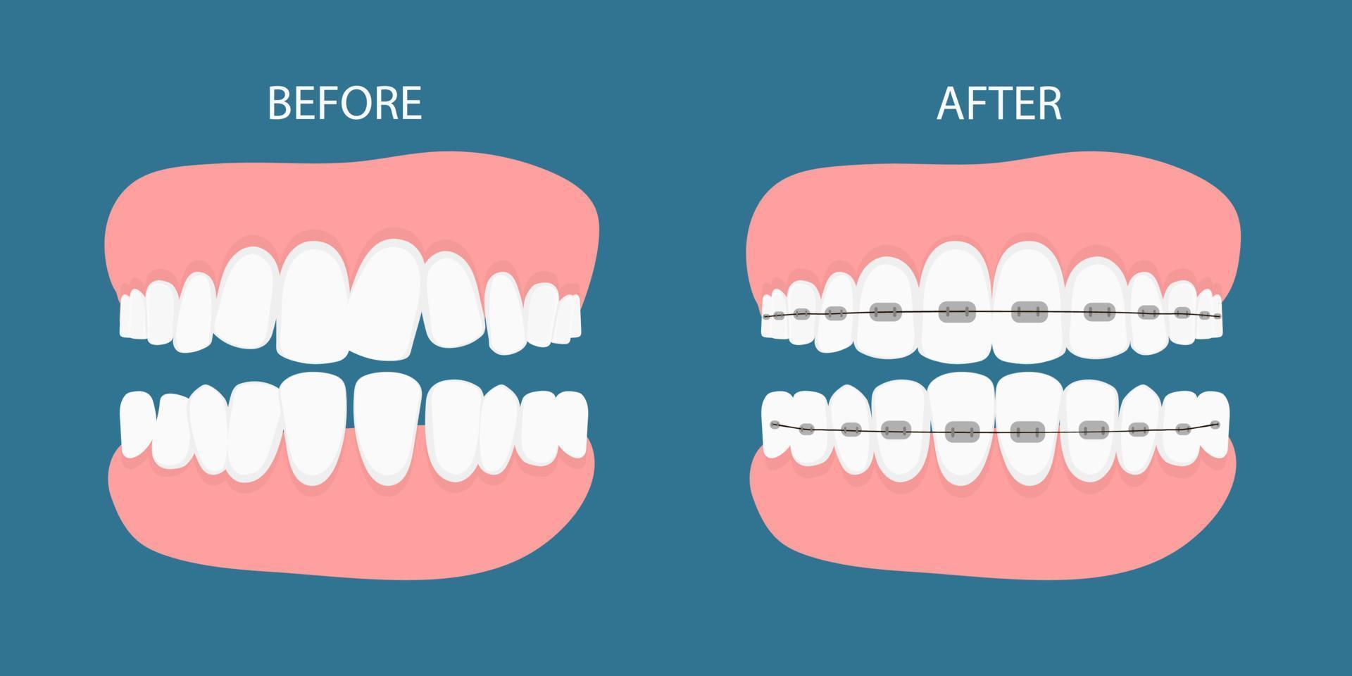 vectorillustratie van stadia van orthodontische behandeling accolades op tanden. tanden voor, na beugel op. achtergrond in vlakke style.vector op blauwe achtergrond. tandheelkundig begrip. vector